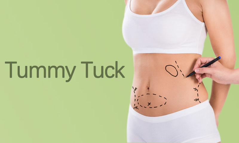 Tummy Tuck