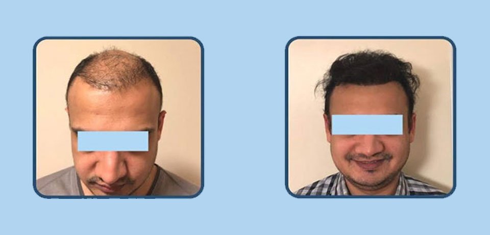 Best Hair Transplant for Men in Surat, Gujarat (India)