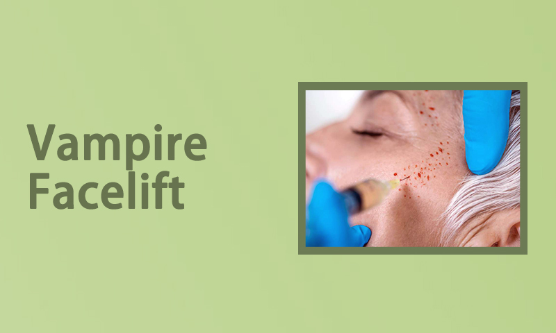 Vampire Facelift in Surat, Gujarat (India)