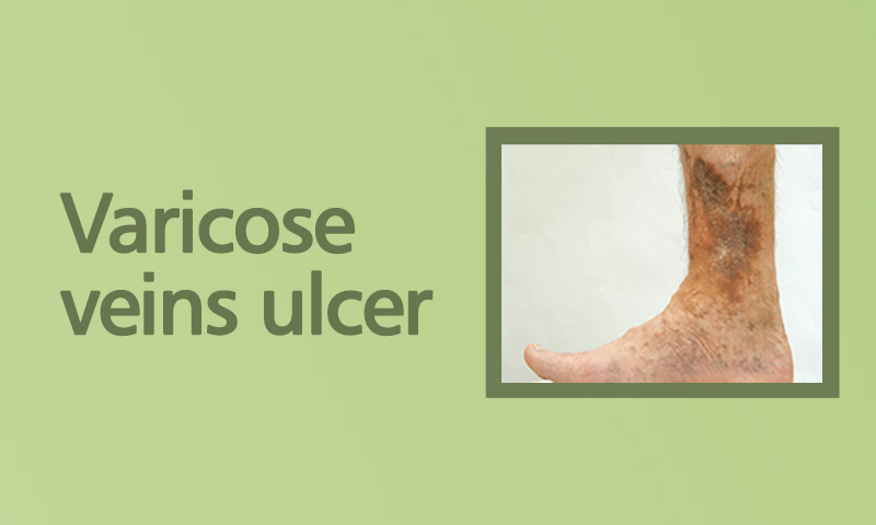 Varicose Veins Ulcer