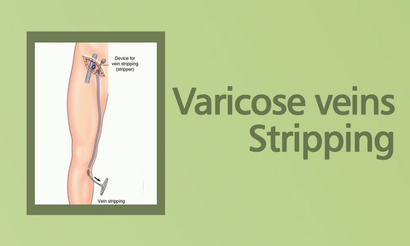 Varicose Veins Stripping