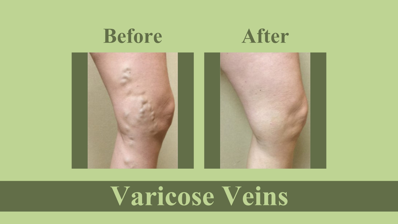 Surgical Management Of Varicose Veins