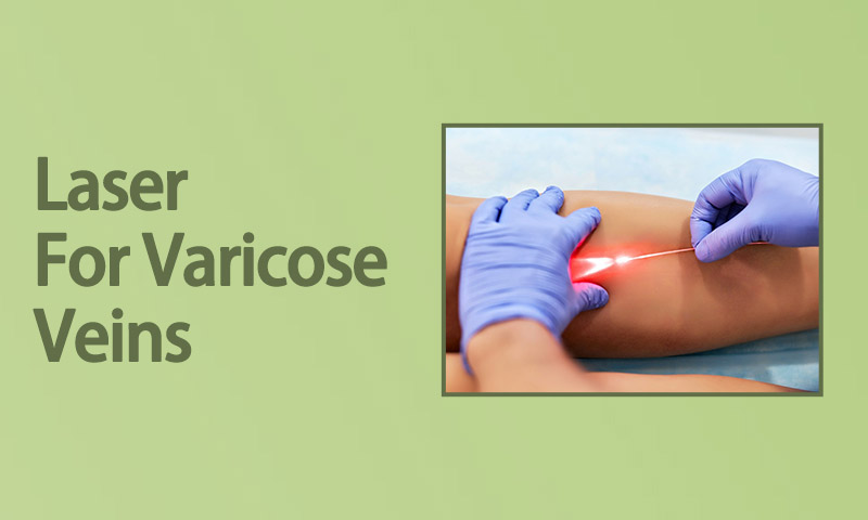 Laser For Varicose Veins