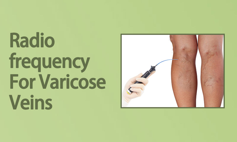 Radiofrequency For Varicose Veins