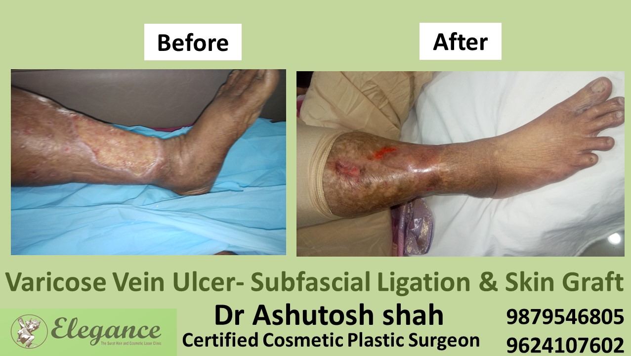 Treatment of Swollen Legs