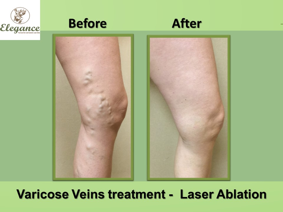 Radiofrequency For Varicose Veins