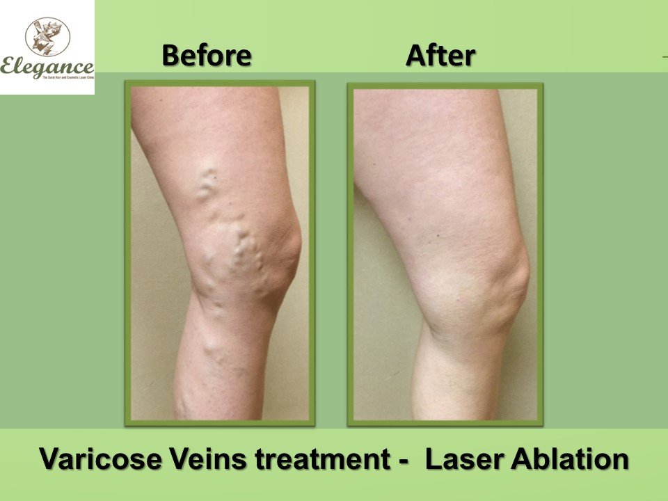 Sclerotherapy For Incompetent Perforators