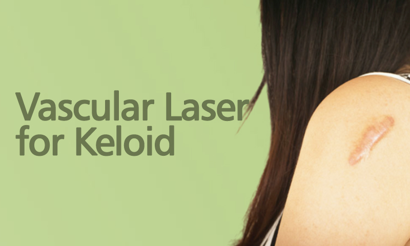 Vascular Laser For Keloid