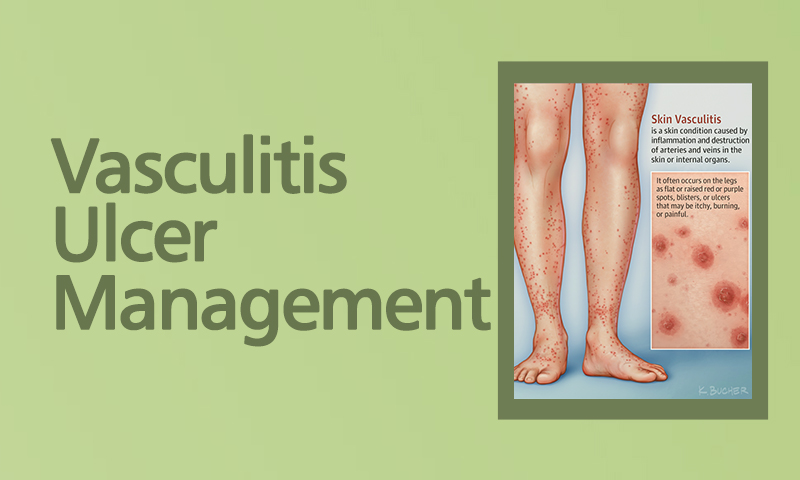 Vasculitis Ulcer Management