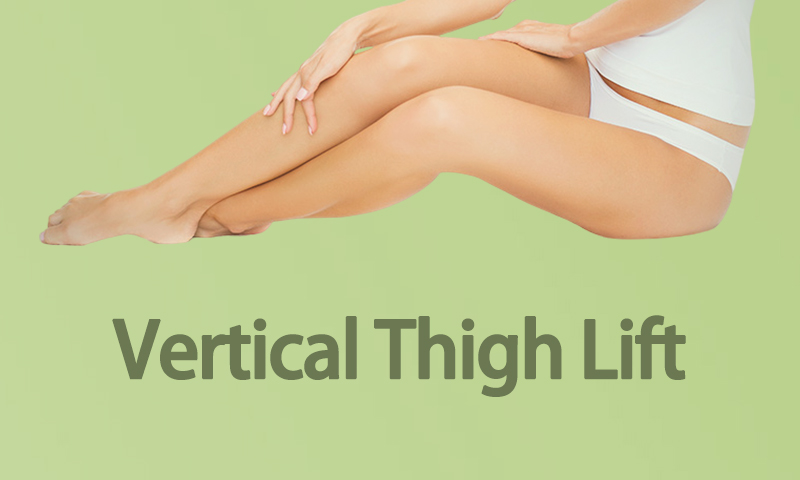 Vertical Thigh Lift