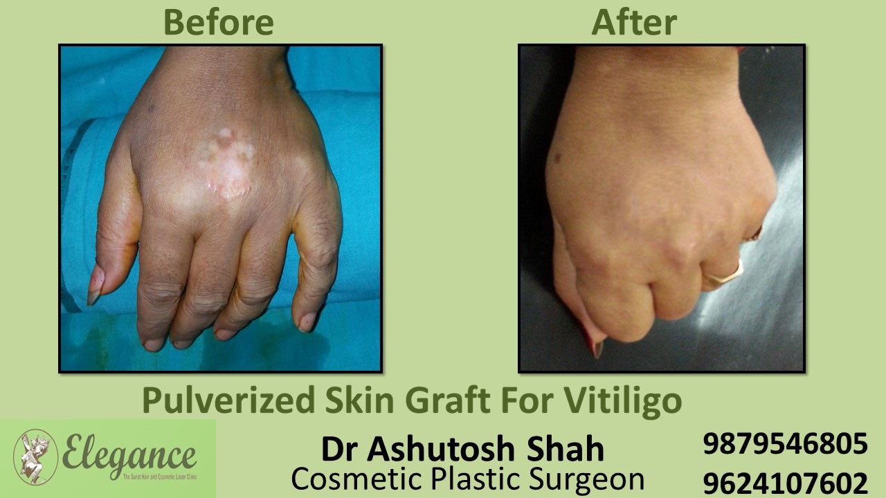 Punch Grafting For Vitiligo