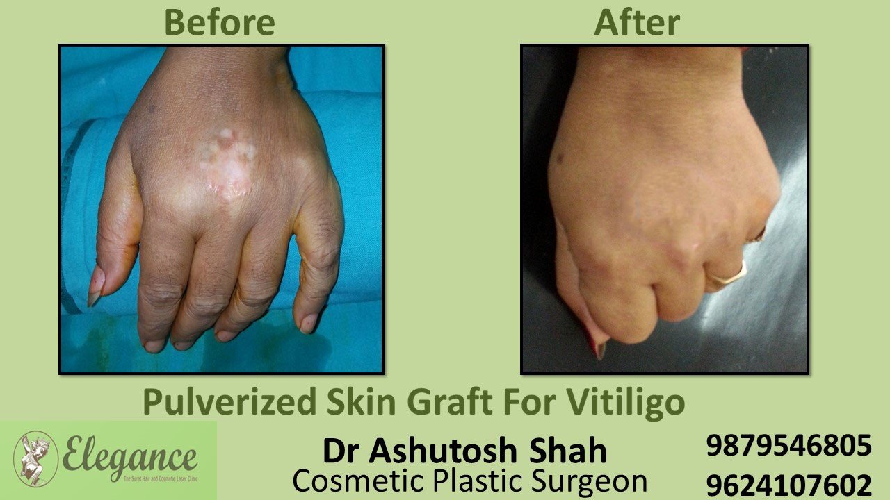 Blister Therapy For Vitiligo