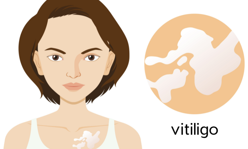 Diet For Vitiligo