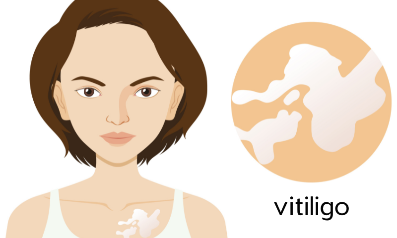 Punch Grafting For Vitiligo