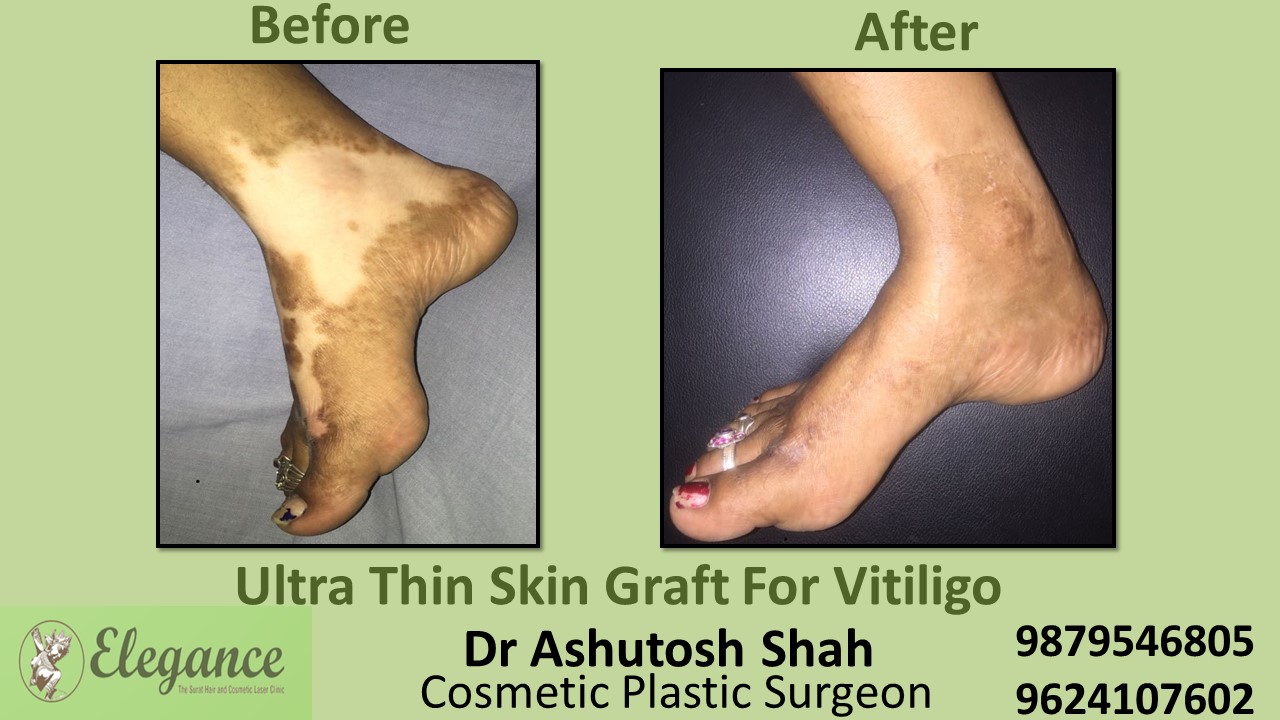 Blister Therapy For Vitiligo